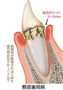 軽度歯周炎